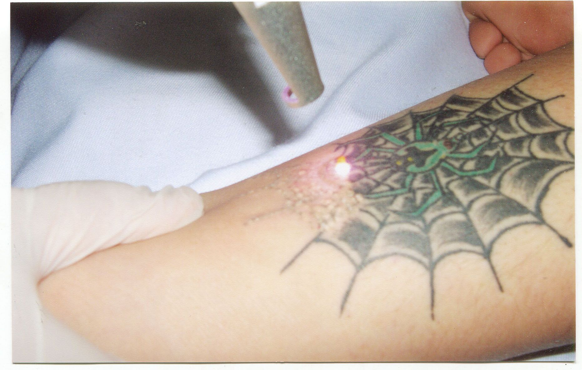 Xóa xăm - Delete tattoo