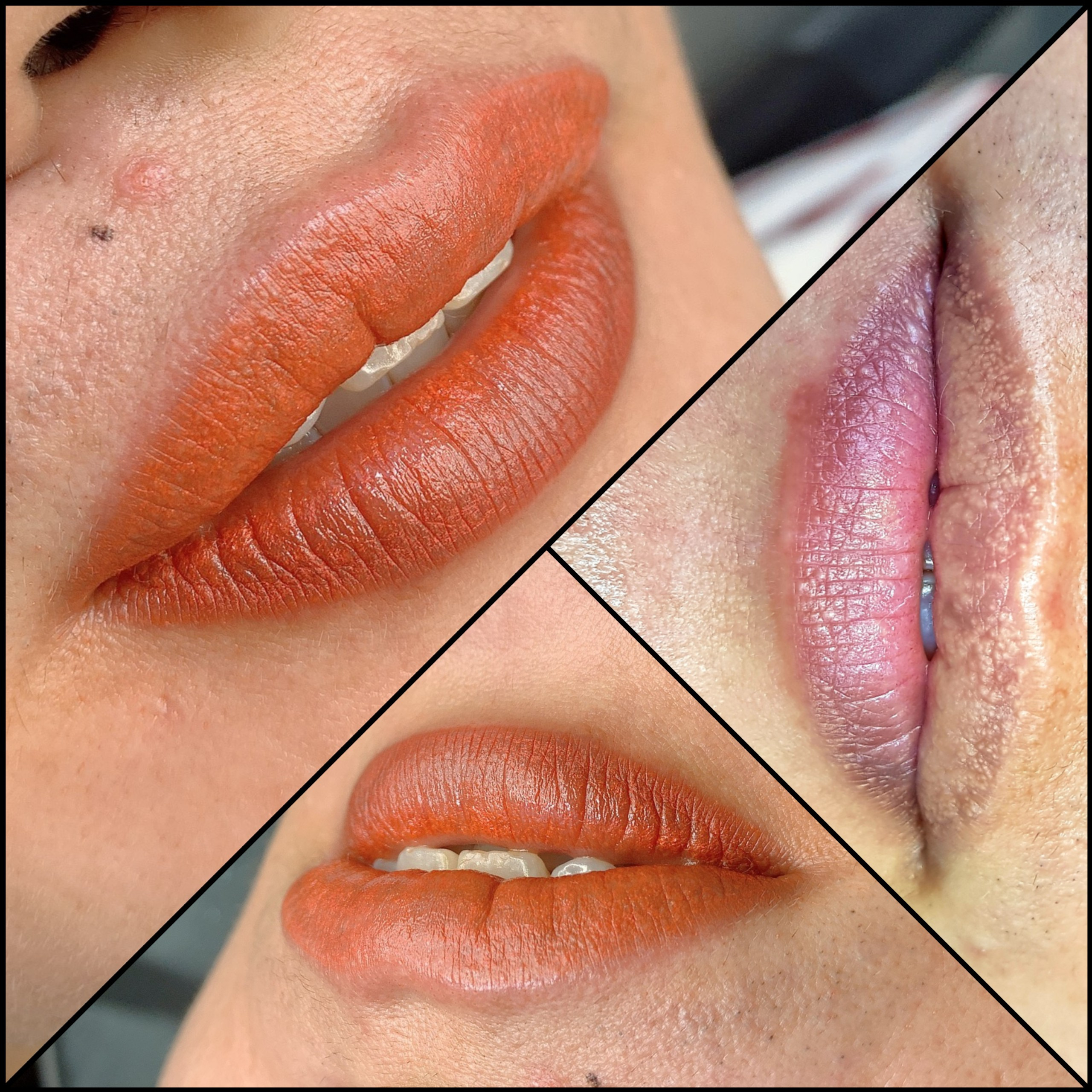 Khử Thâm Môi - Nam / Nữ - Dark Lips Removal for Man / Woman